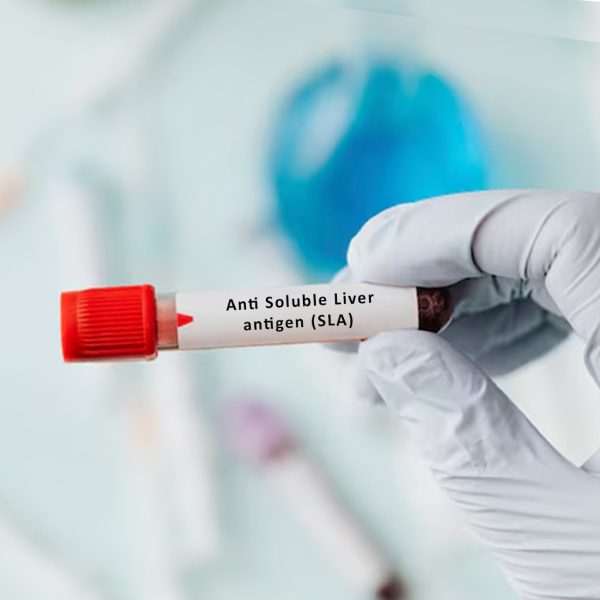 Anti Soluble Liver antigen (SLA)