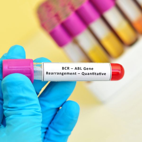 BCR – ABL Gene Rearrangement – Quantitative