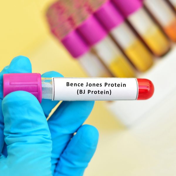 Bence Jones Protein (BJ Protein)