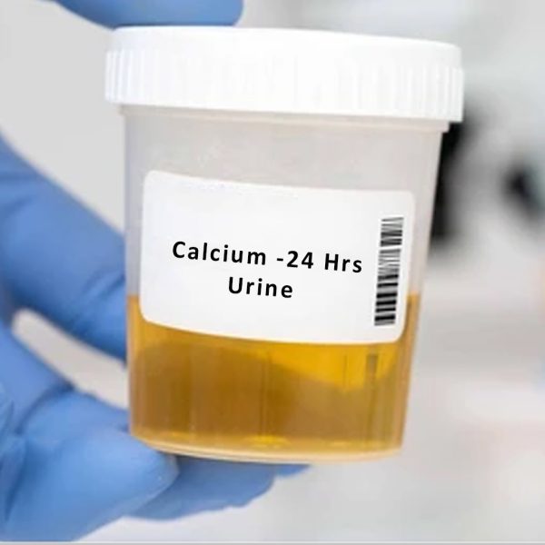 Calcium -24 Hrs Urine