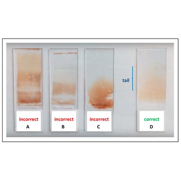 Cytology -Fluids-Air Dried Smears